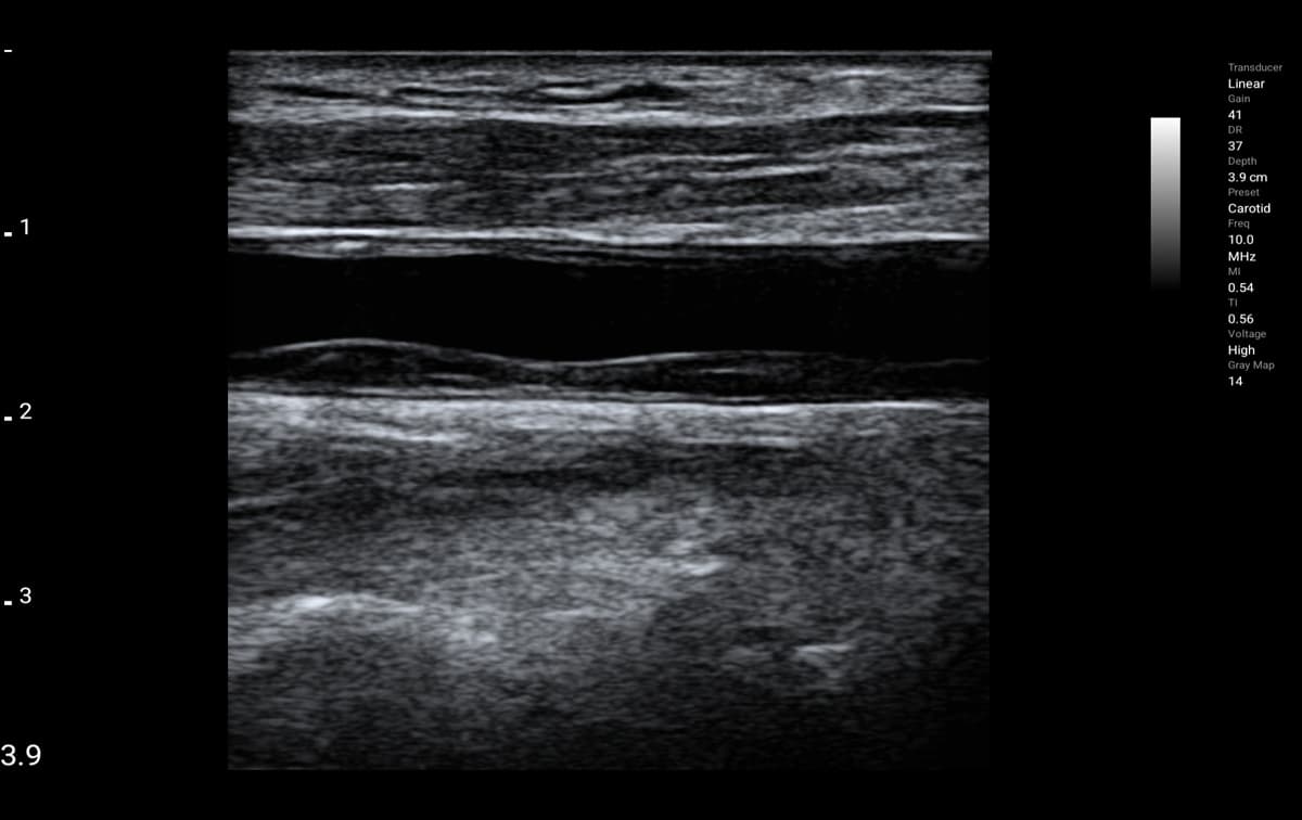 Common carotid artery plaque imaged in B-mode on the ASUS LU800