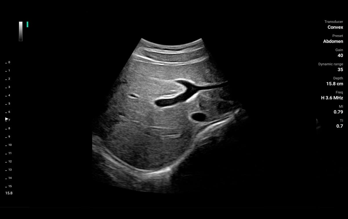 B mode on the ASUS LU800: Convex probe, abdomen preset, 15.8 cm depth, H 3.6 MHz