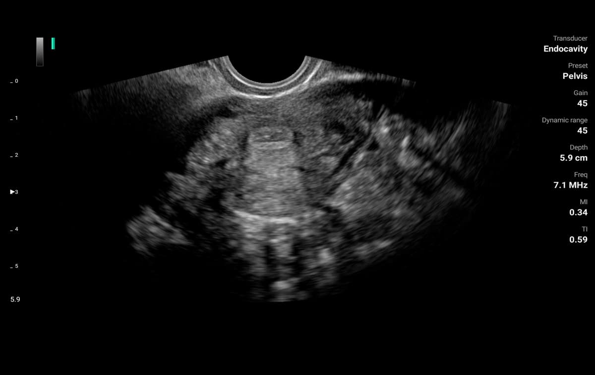 Pelvic B-mode image on the ASUS LU800E endocavity probe