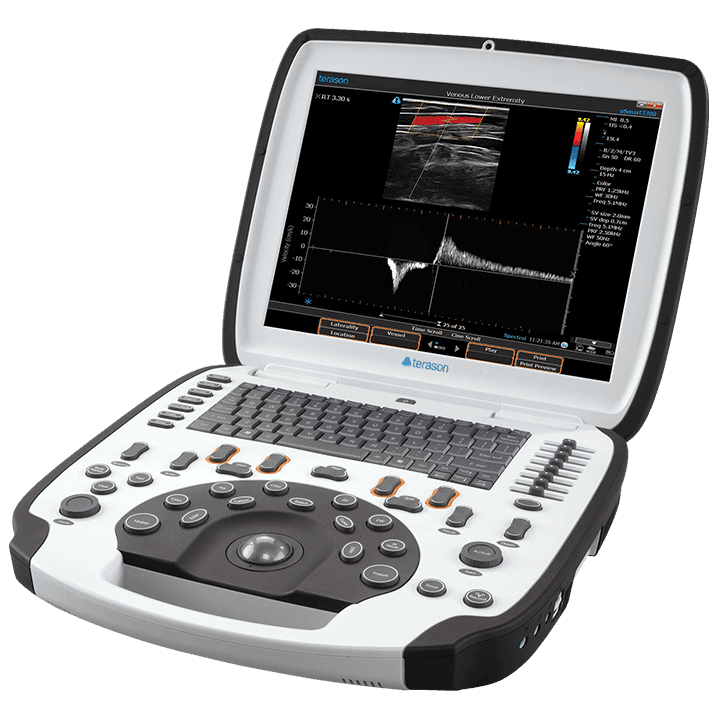 Terason uSmart 3300 NexGen ultrasound system showing a venous lower extremity duplex exam