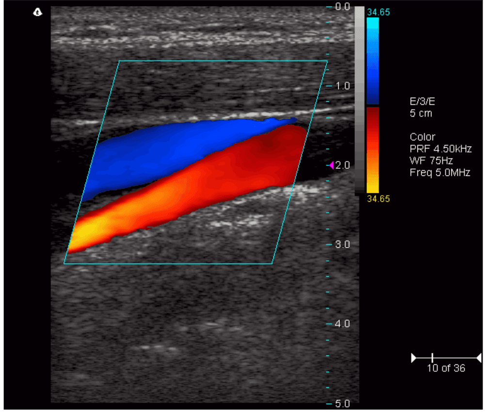 Terason Color Doppler example scan