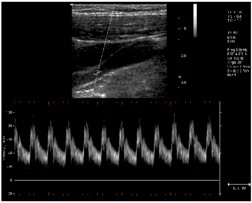 Terason Pulsed-Wave Doppler example scan